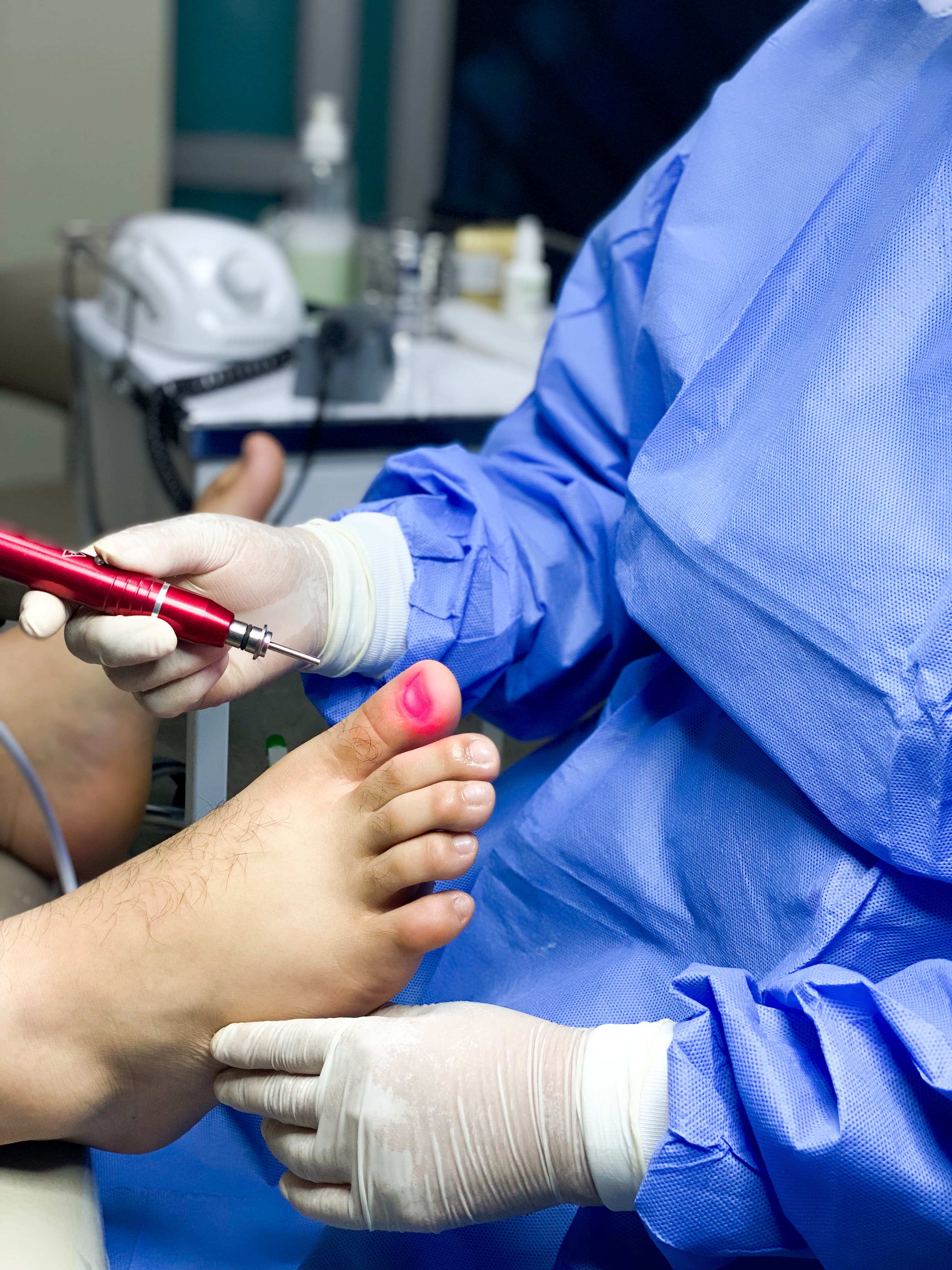 ¿Hongos en las uñas? No los escondas, elimínalos