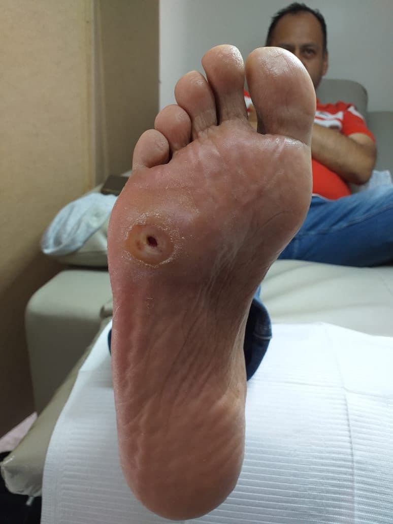 Pie Diabético: La importancia de la prevención